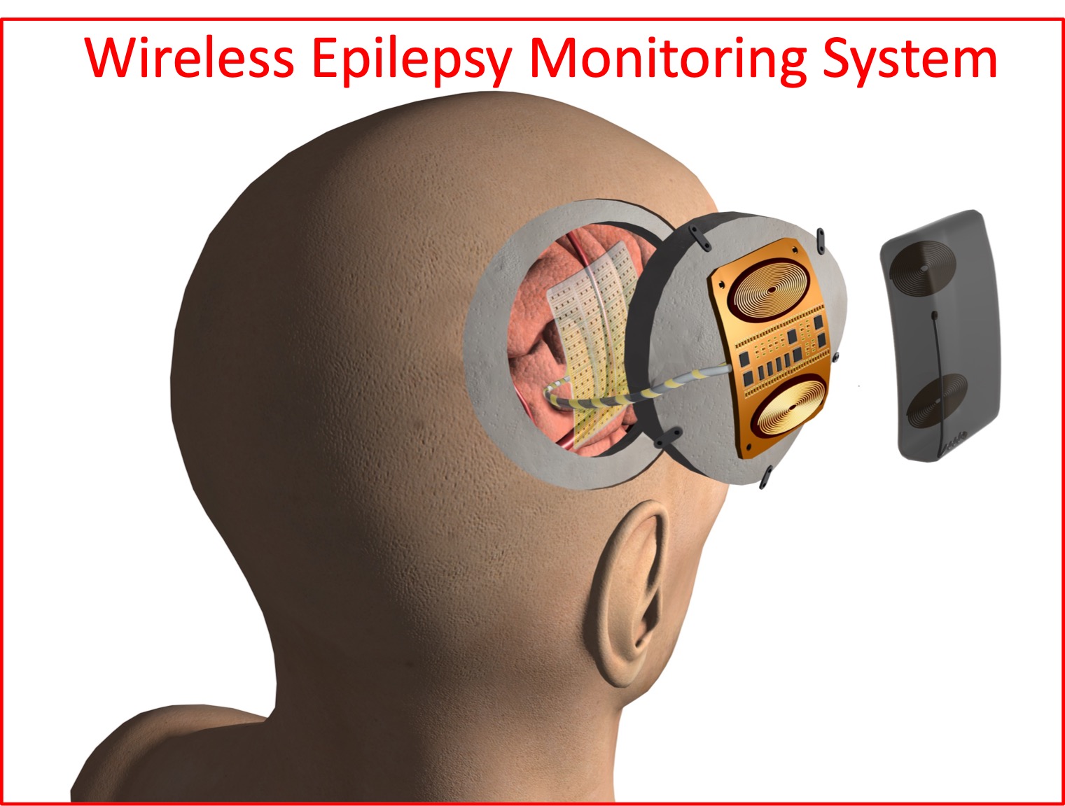 Wireless High Channel Count Epilepsy Monitoring System